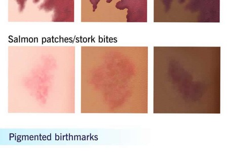 Birthmarks