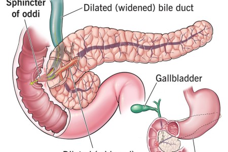 Sphincter of Oddi Dysfunction