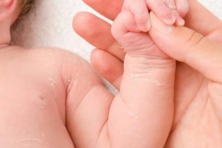 If Your Newborn Has Peeling Skin, Here’s What That Means