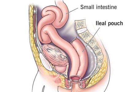 J-Pouch Surgery