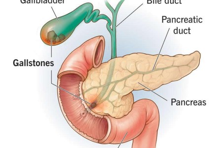 Gallstones