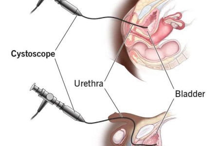 Cystoscopy