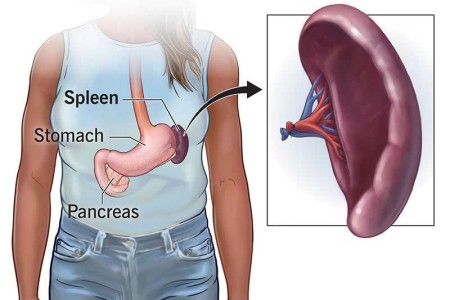 Splenectomy