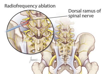 Rhizotomy