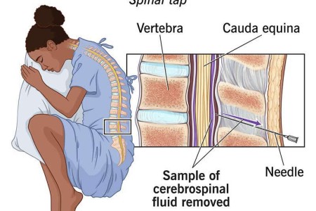 Lumbar Puncture (Spinal Tap)