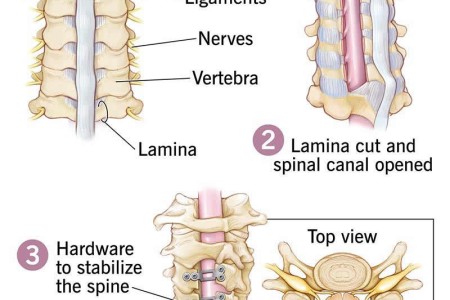 Laminoplasty