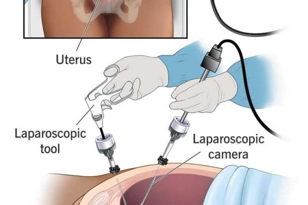 Laparoscopy