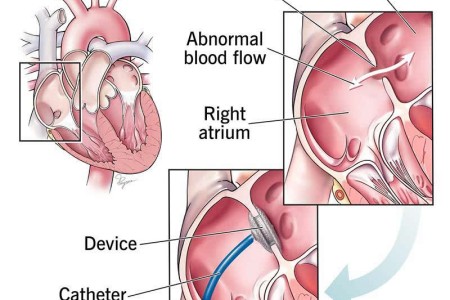 Patent Foramen Ovale (PFO)