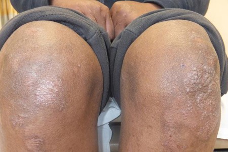 Epidermolysis Bullosa