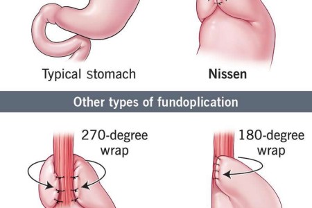 Nissen Fundoplication