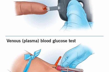 Blood Glucose (Sugar) Test