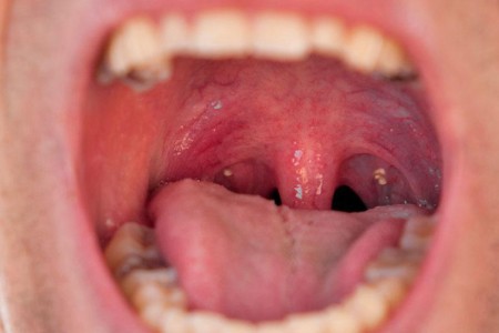 Tonsil Stones