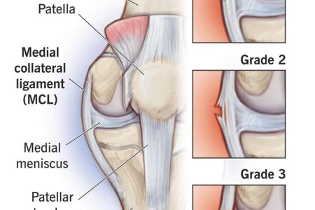 Knee Sprain
