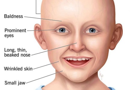 Progeria