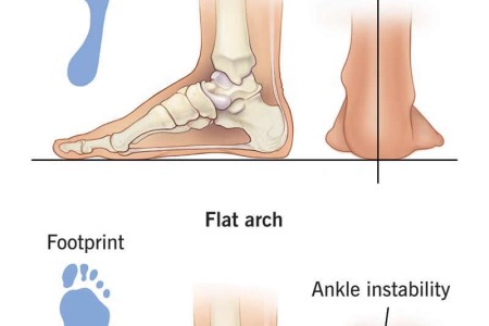 Flat Feet (Pes Planus)