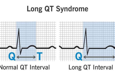 Long QT Syndrome (LQTS)