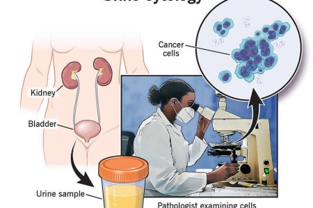 Urine Cytology