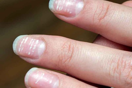 White Spots on Nails (Leukonychia)