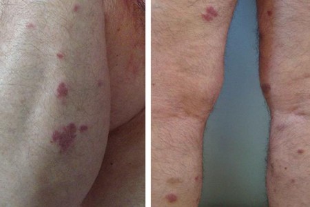 Kaposi Sarcoma