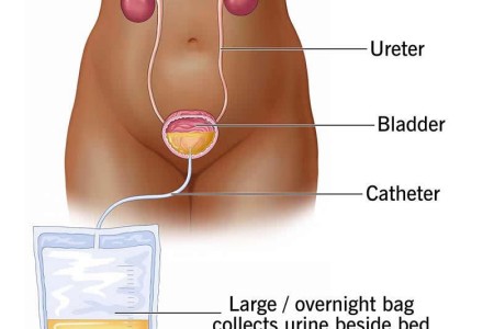 Urine Drainage Catheter Bags