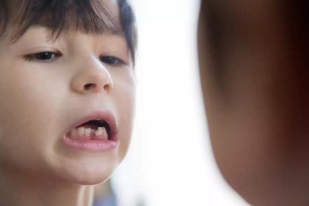 Smile Salvation: What To Do if Your Kid’s Tooth Is Knocked Loose