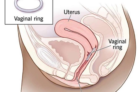 Vaginal Ring