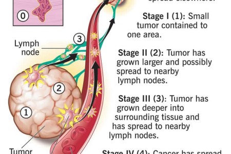 Cancer Staging