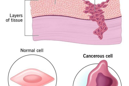 Cancer