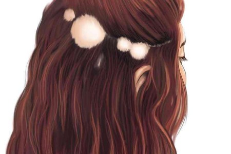 Alopecia Areata