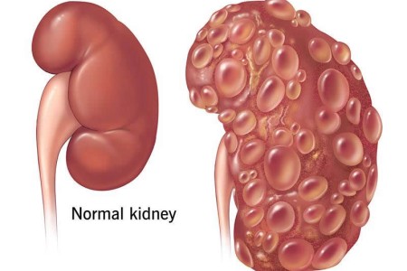 Polycystic Kidney Disease