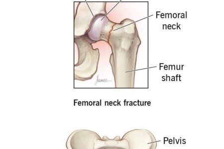 Hip Fracture (Broken Hip)