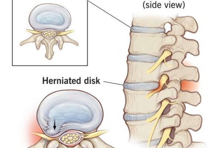 Herniated Disk (Slipped or Bulging Disk)