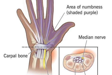 Carpal Tunnel Syndrome