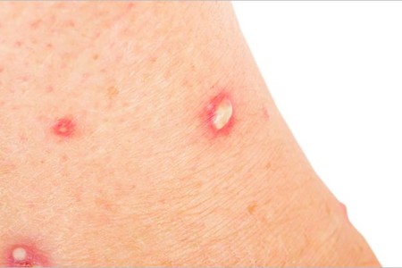 Ant Bites