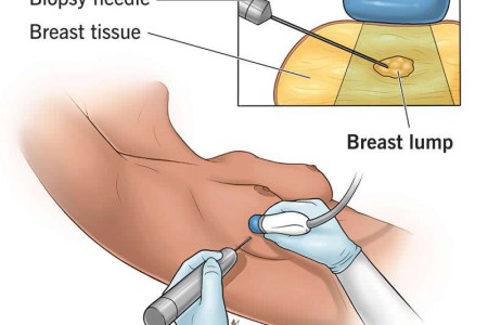 Breast Biopsy