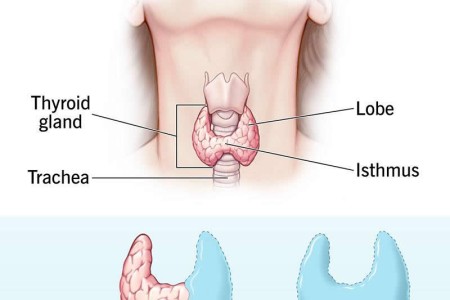 Thyroidectomy