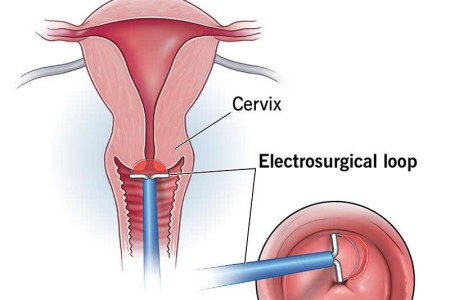 Loop Electrosurgical Excision Procedure (LEEP)
