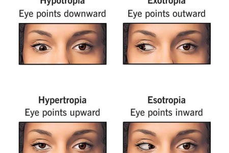 Strabismus (Eye Misalignment)
