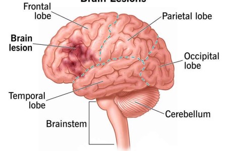 Brain Lesions