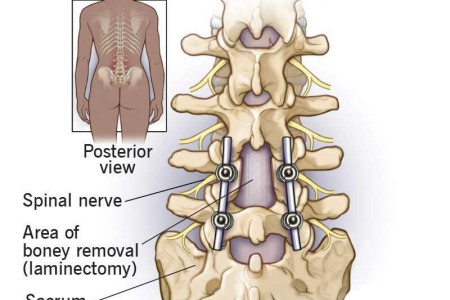 PLIF (Posterior Lumbar Interbody Fusion) Surgery