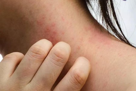How Lifestyle Changes and Self-Care Can Improve Your Atopic Dermatitis