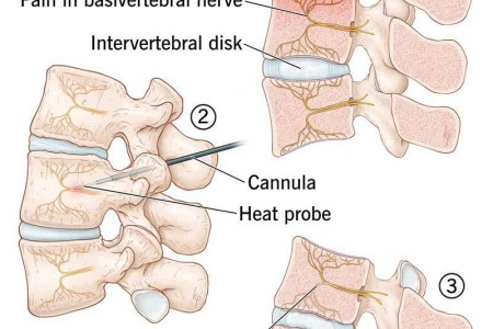 Intracept Procedure (Basivertebral Nerve Ablation)