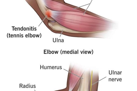 Elbow Pain