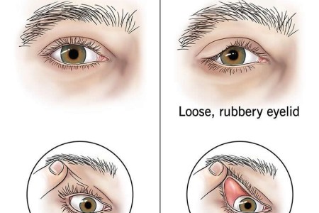Floppy Eyelid Syndrome