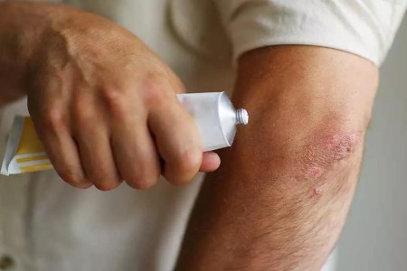 When Home Remedies Won’t Do: Treatment Options for Atopic Dermatitis