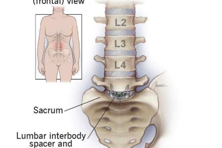 Anterior Lumbar Interbody Fusion (ALIF)