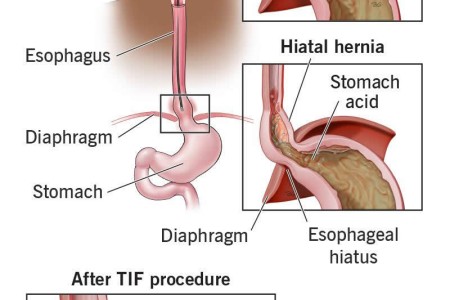 TIF Procedure (Transoral Incisionless Fundoplication)