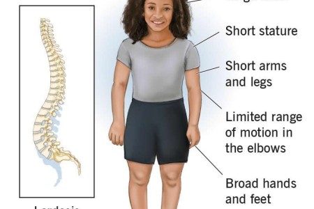 Hypochondroplasia