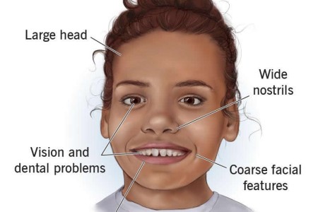 Costello Syndrome