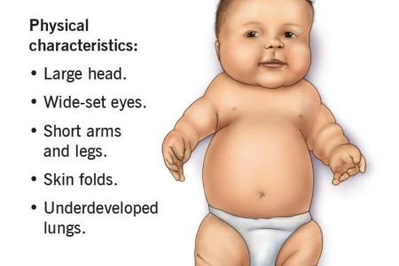 Thanatophoric Dysplasia
